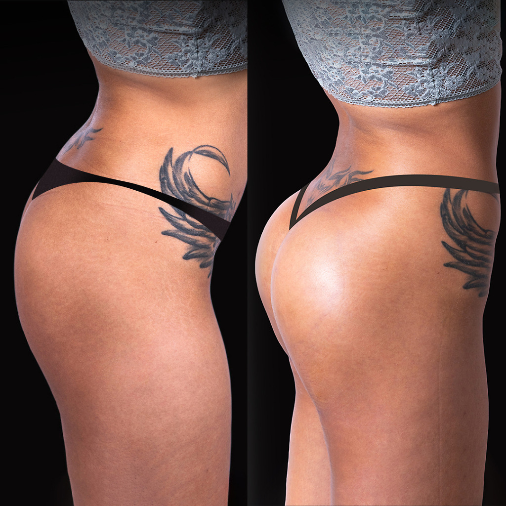 Before and after BBL results, Natural Clinic Turkey, improved shape and proportions