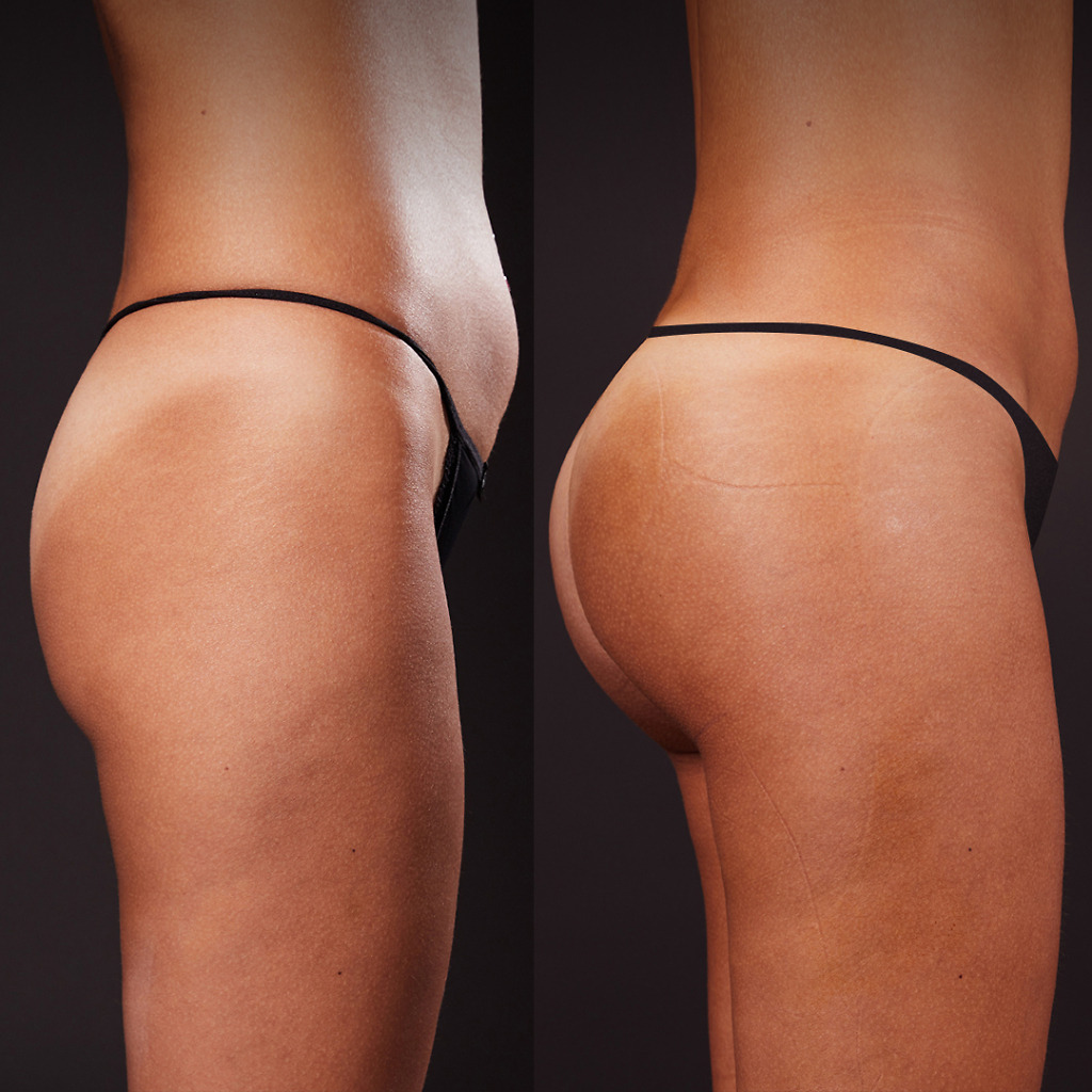 Brazilian Butt Lift results in Turkey, posture-improving buttock augmentation