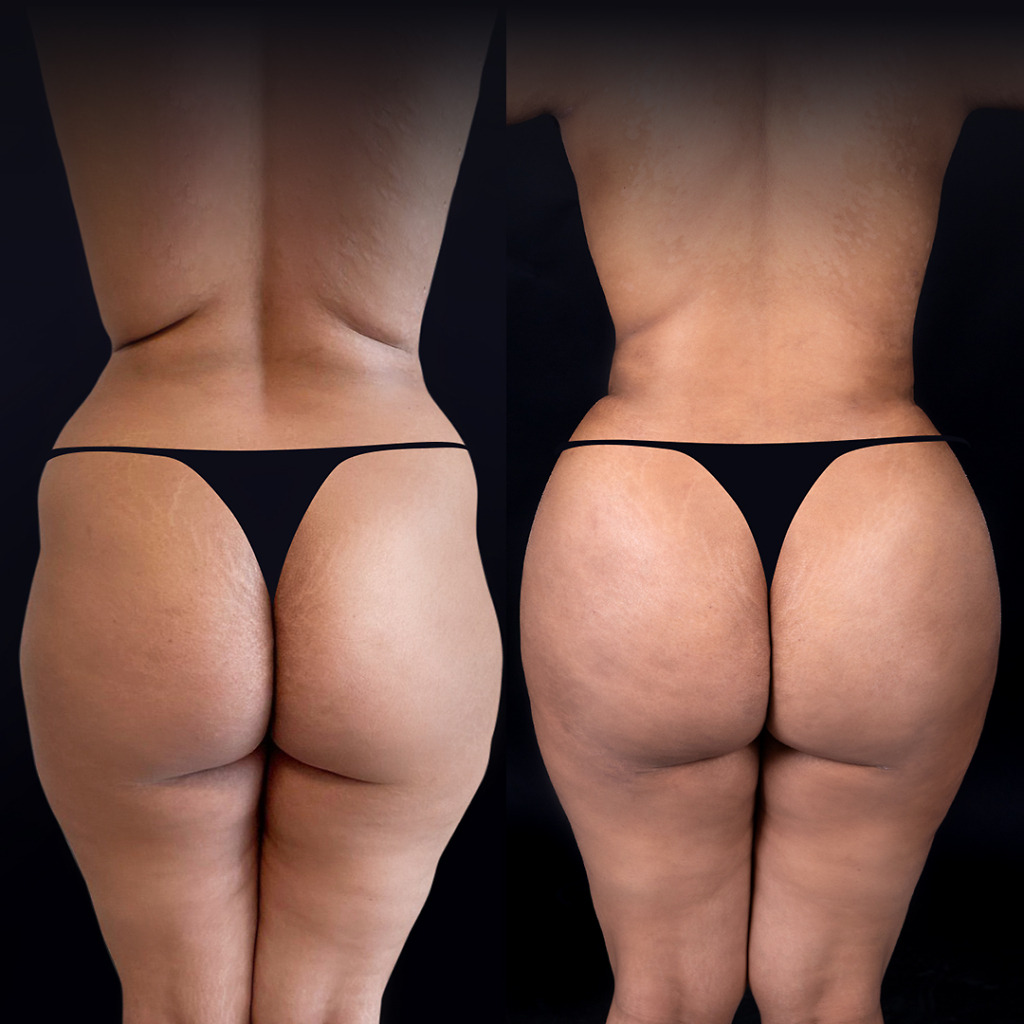 Comprehensive BBL transformation, full-body silhouette at Natural Clinic Turkey