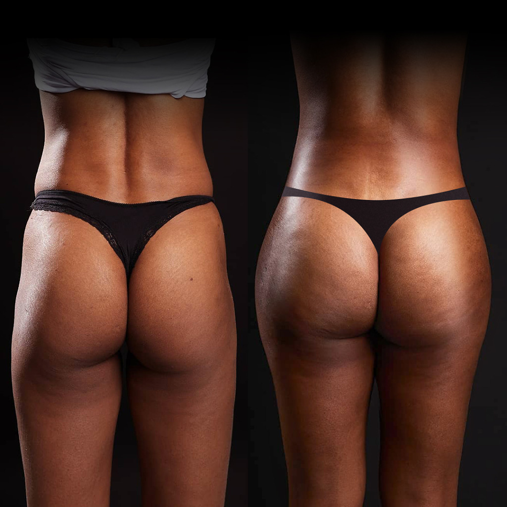 Brazilian Butt Lift in Turkey, highlighting waistline definition and enhanced buttock projection at Natural Clinic