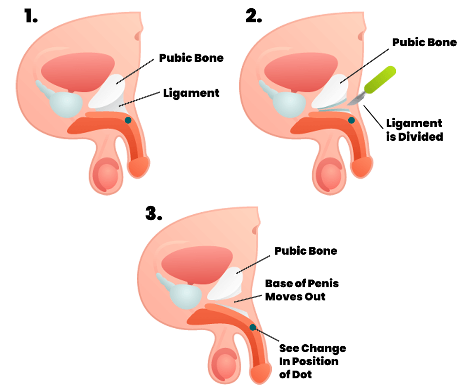 Illustration showing the different stages of penis enlargement surgery