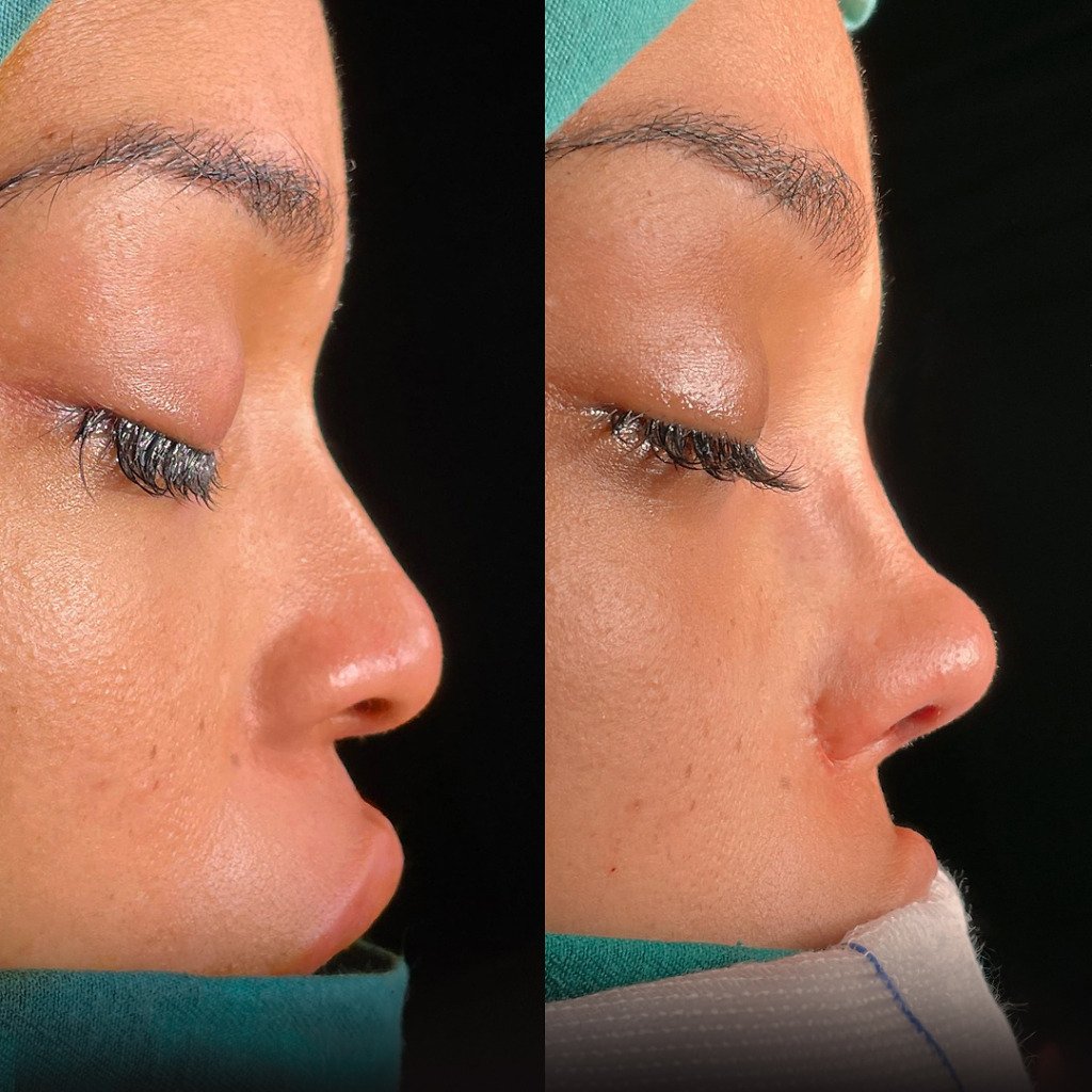 rhinoplasty-before-and-after-turkey (1)