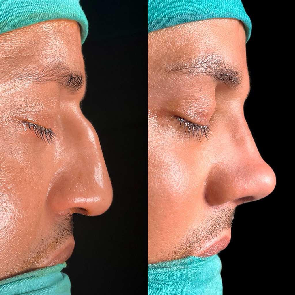 Male rhinoplasty before and after for deviated septum correction