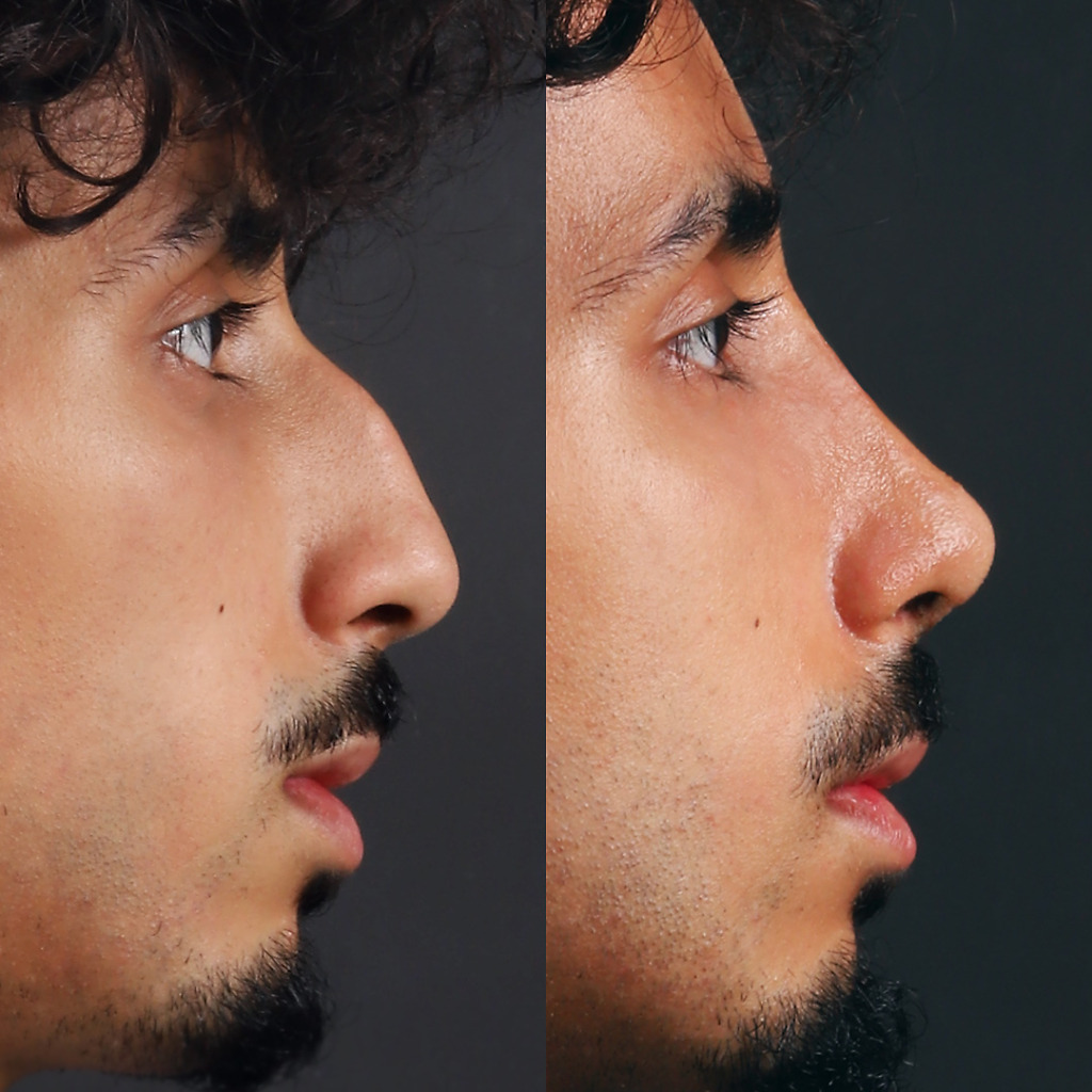 Ethnic rhinoplasty before and after results in a male patient