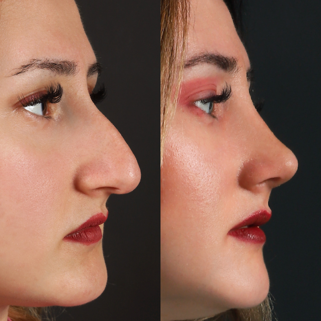 Female rhinoplasty before and after using open and closed techniques