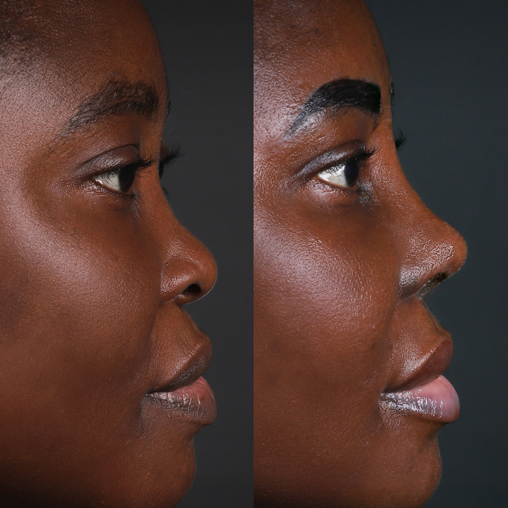 Female ethnic rhinoplasty before and after showcasing natural results