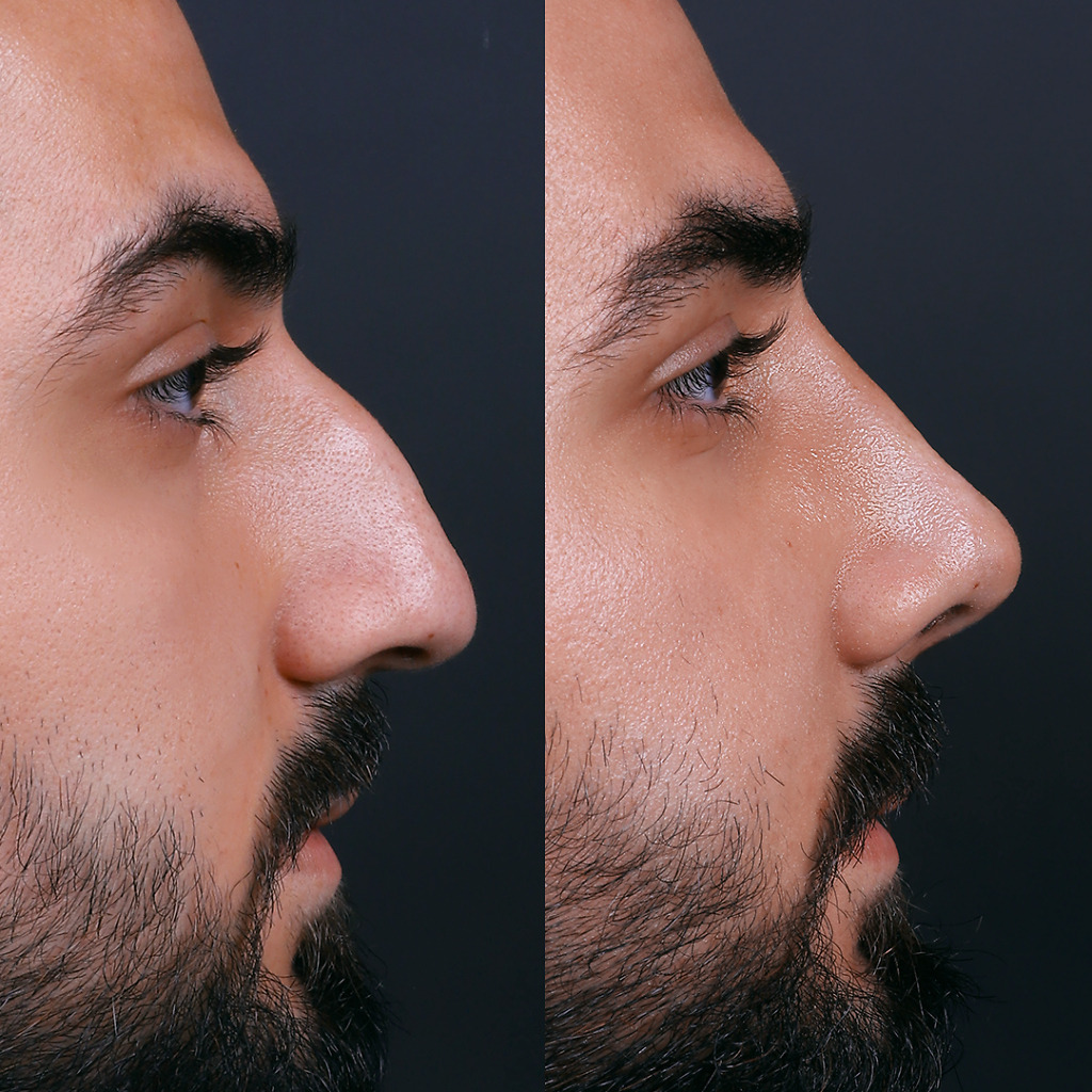 Before and after rhinoplasty using open vs. closed technique in a male patient