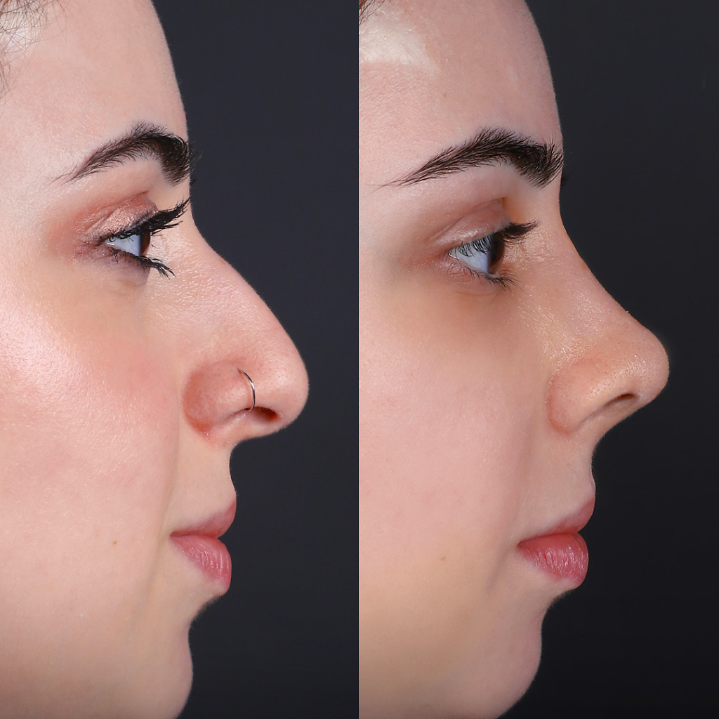 rhinoplasty-before-and-after-turkey (15)