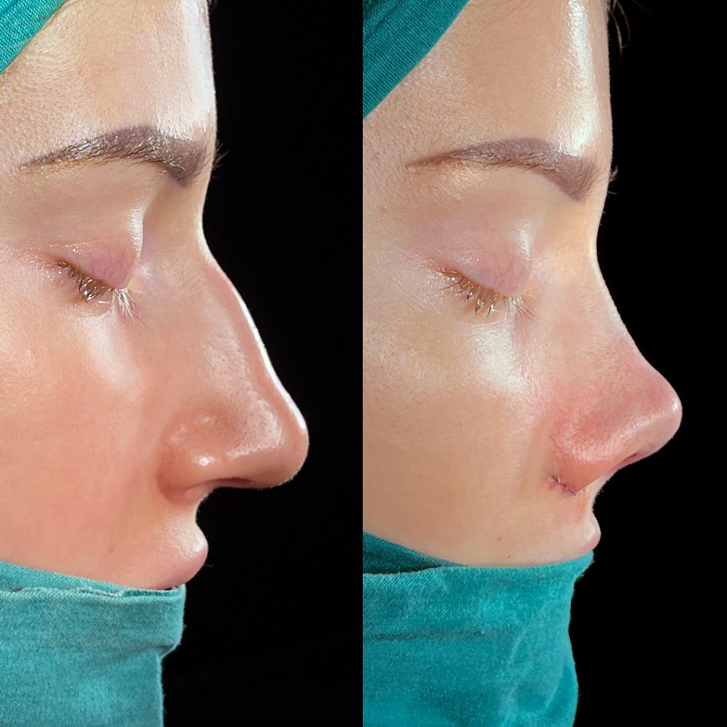 Front view of a female rhinoplasty before and after transformation