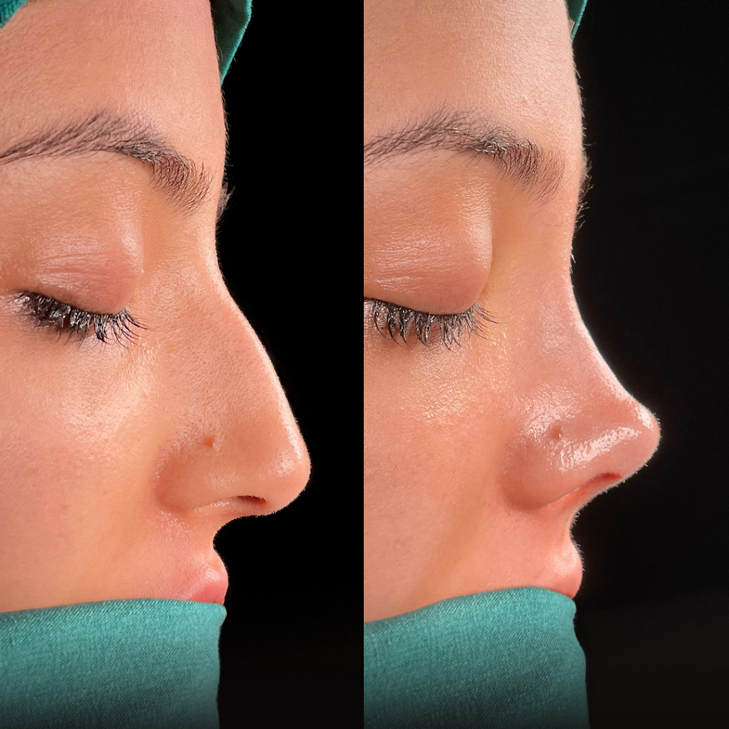 rhinoplasty-before-and-after-turkey (19)