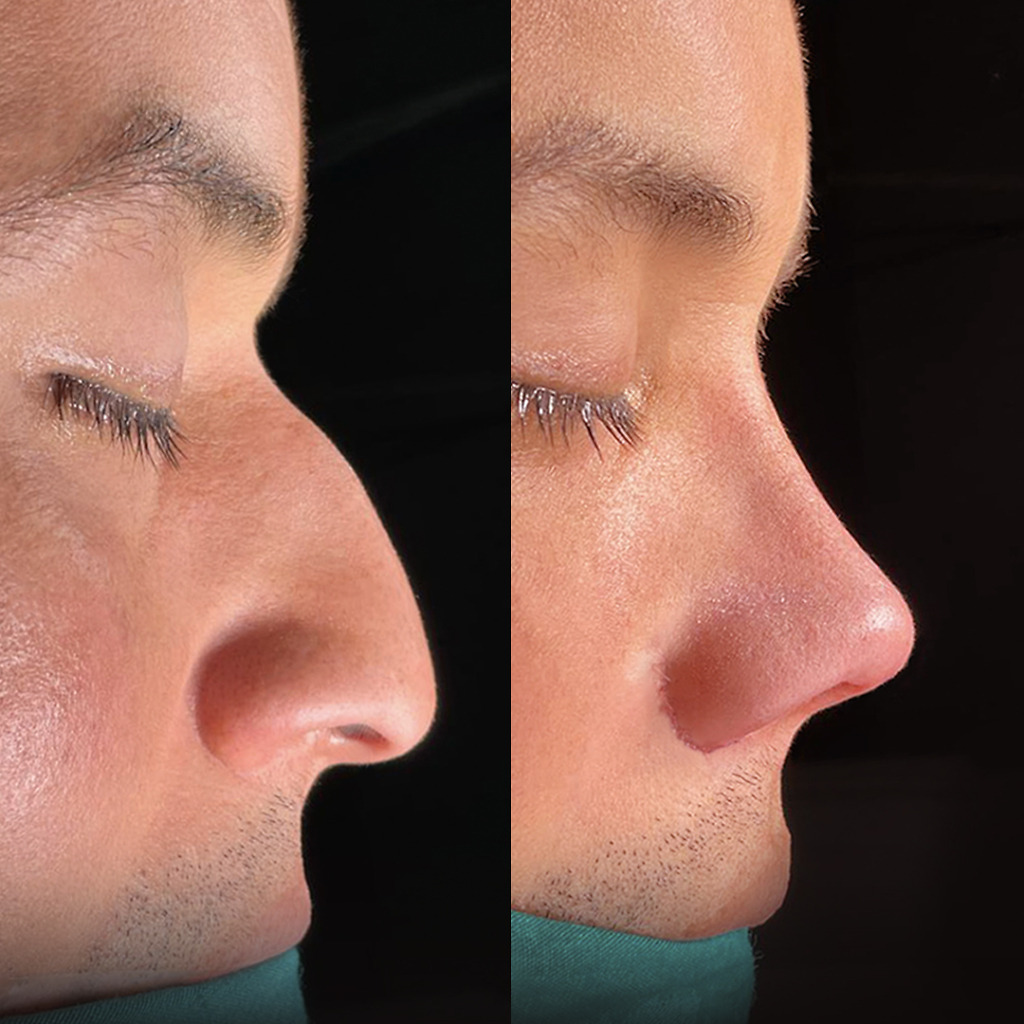 Before and after rhinoplasty correcting nasal asymmetry in a male patient