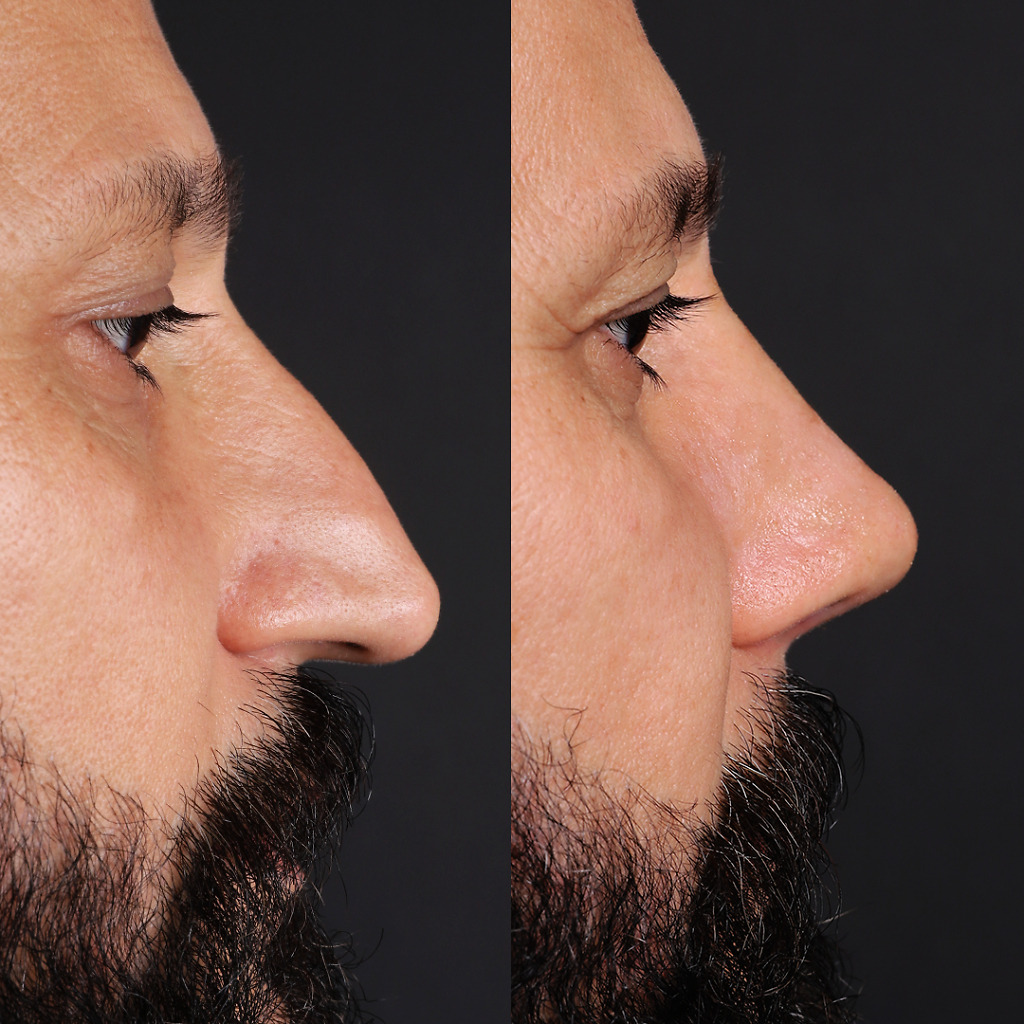 Before and after hump reduction rhinoplasty in a male patient