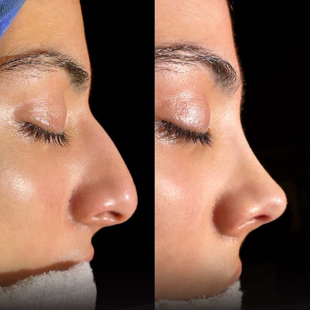 Female rhinoplasty before and after tip refinement results