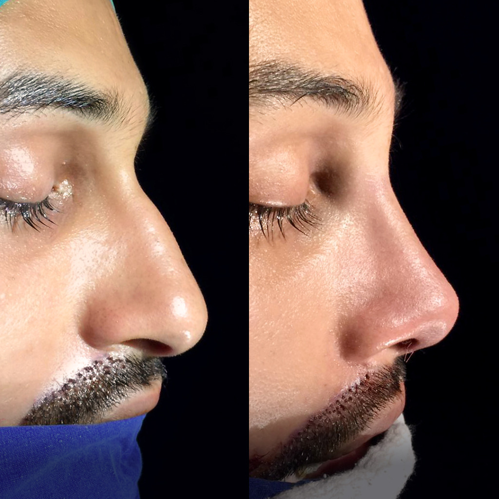 Male rhinoplasty before and after side profile transformation