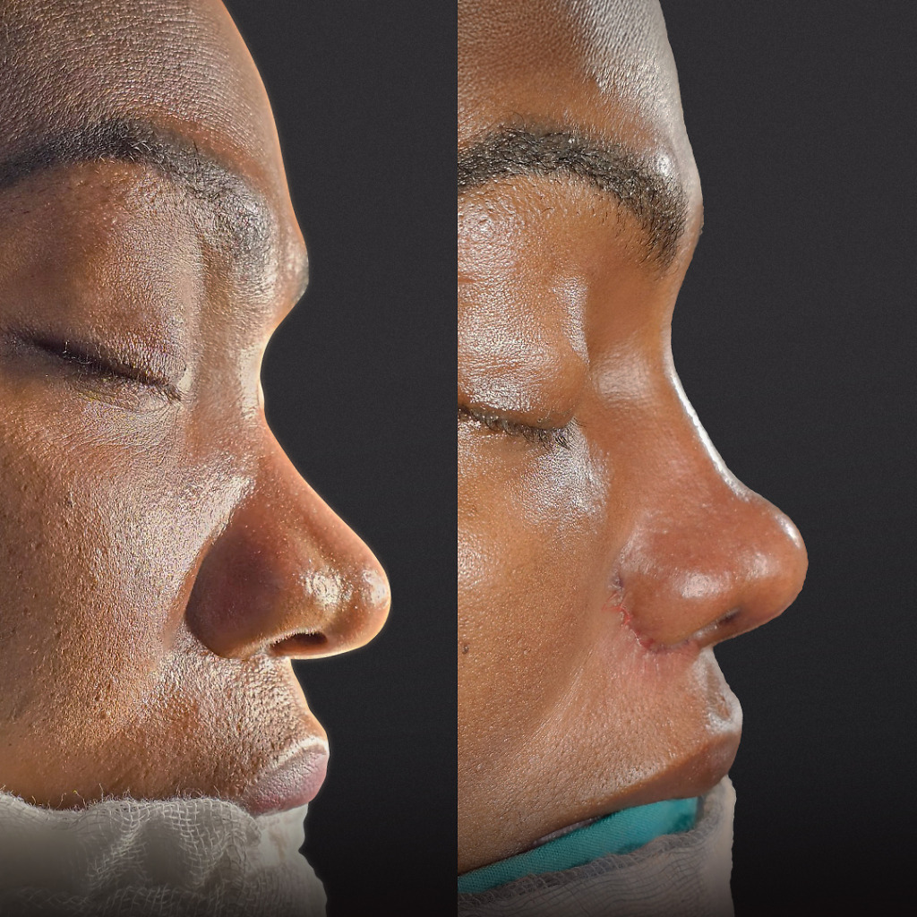 Female rhinoplasty before and after showing a refined nose shape