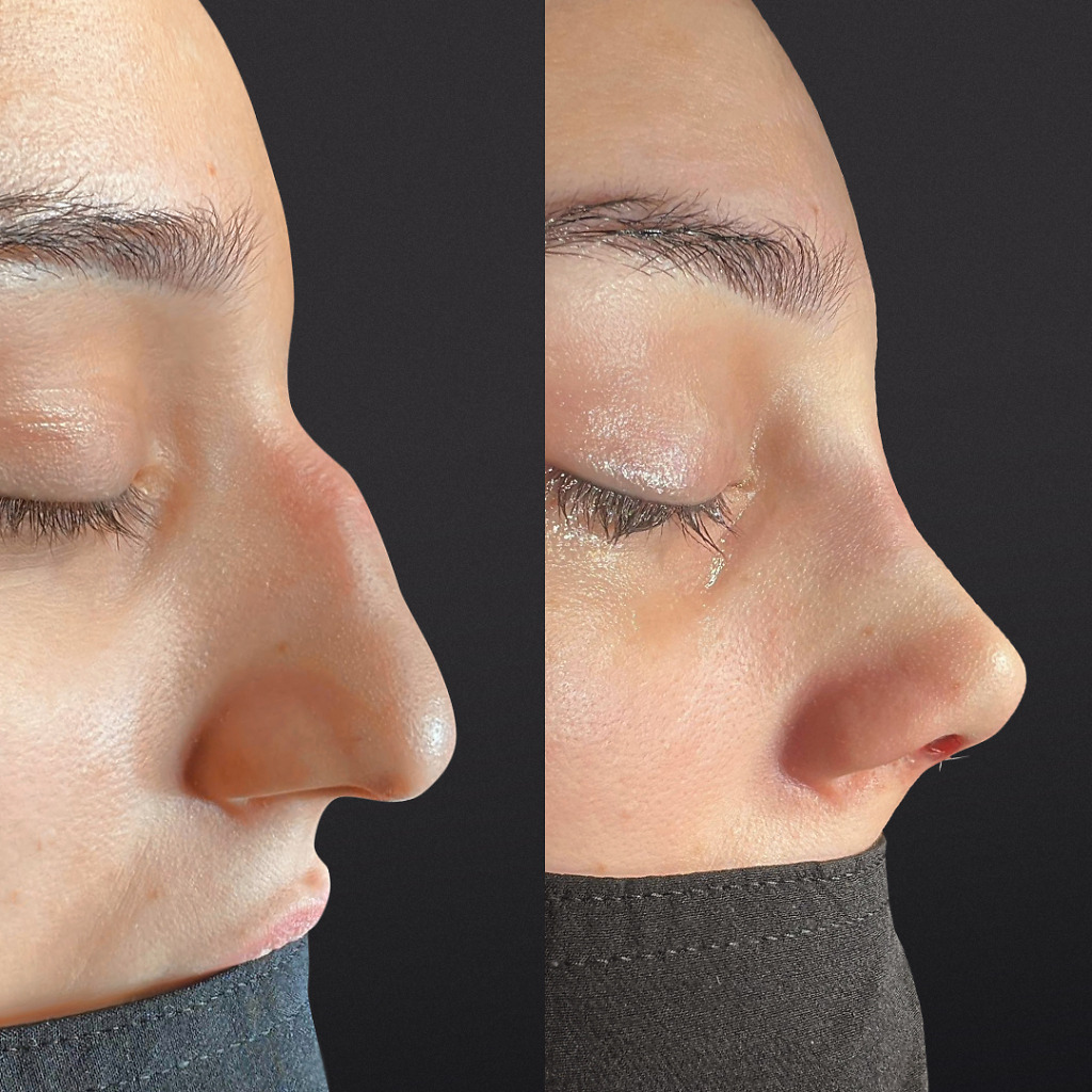 Female rhinoplasty before and after showing nasal asymmetry correction