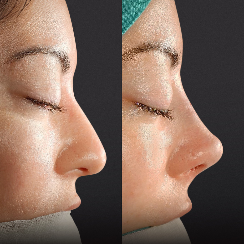 Female rhinoplasty before and after showing a softer nasal contour