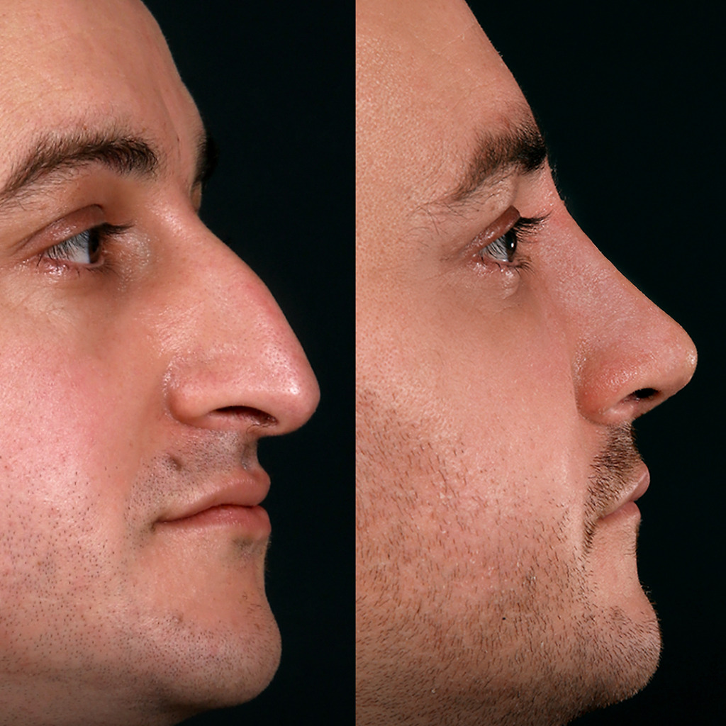 Before and after tip refinement rhinoplasty for a male patient