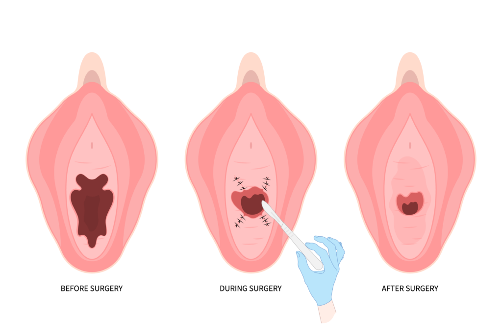 Labiaplasty step-by-step diagram: before, during, and after surgery