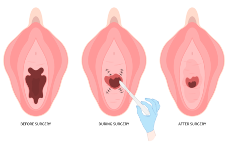 Labiaplasty step-by-step diagram: before, during, and after surgery