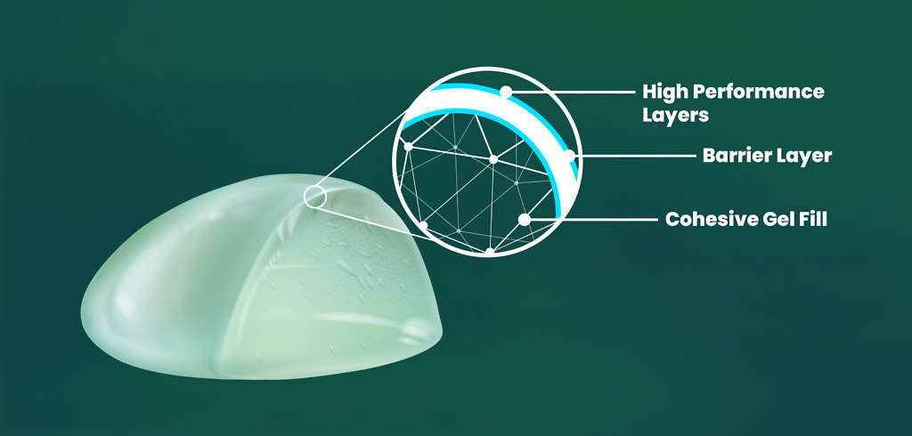 High-performance layered breast implant with cohesive gel fill