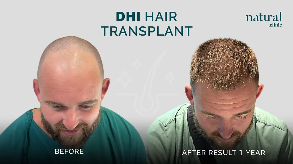 Blog DHI Hair transplant x