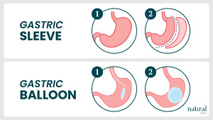 Gastric Balloon vs. Gastric Sleeve in Turkey