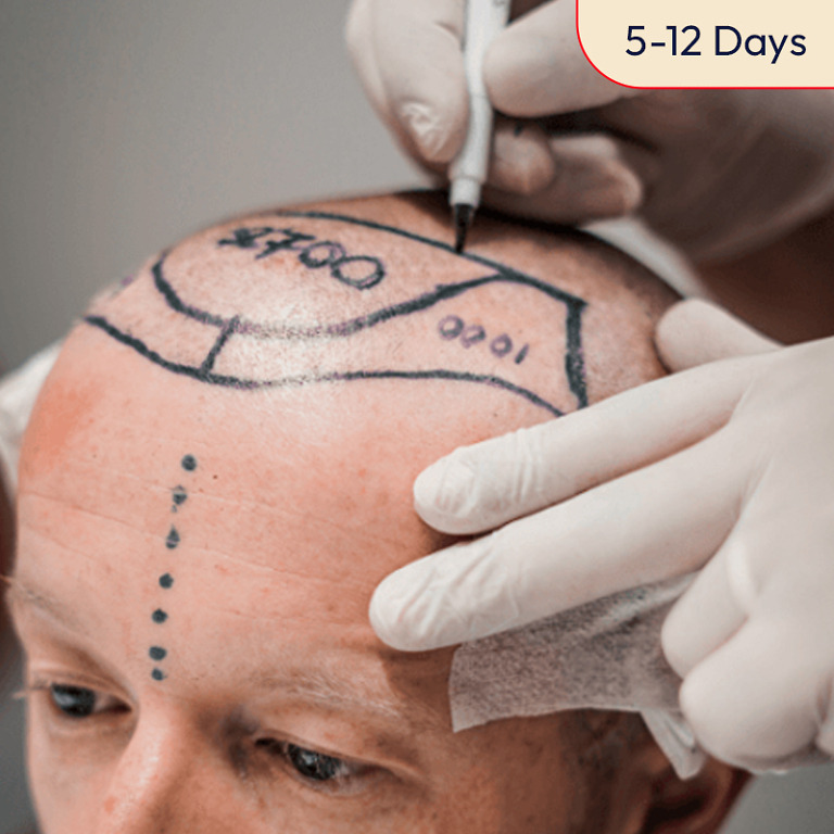hair transplant site prep e  x