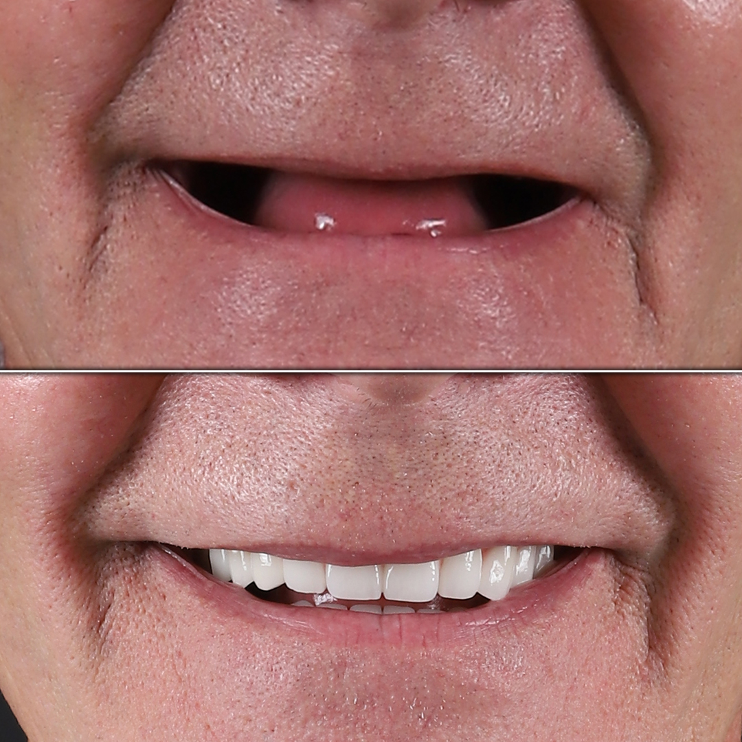Dental_Implant_1-kopya-1.jpg