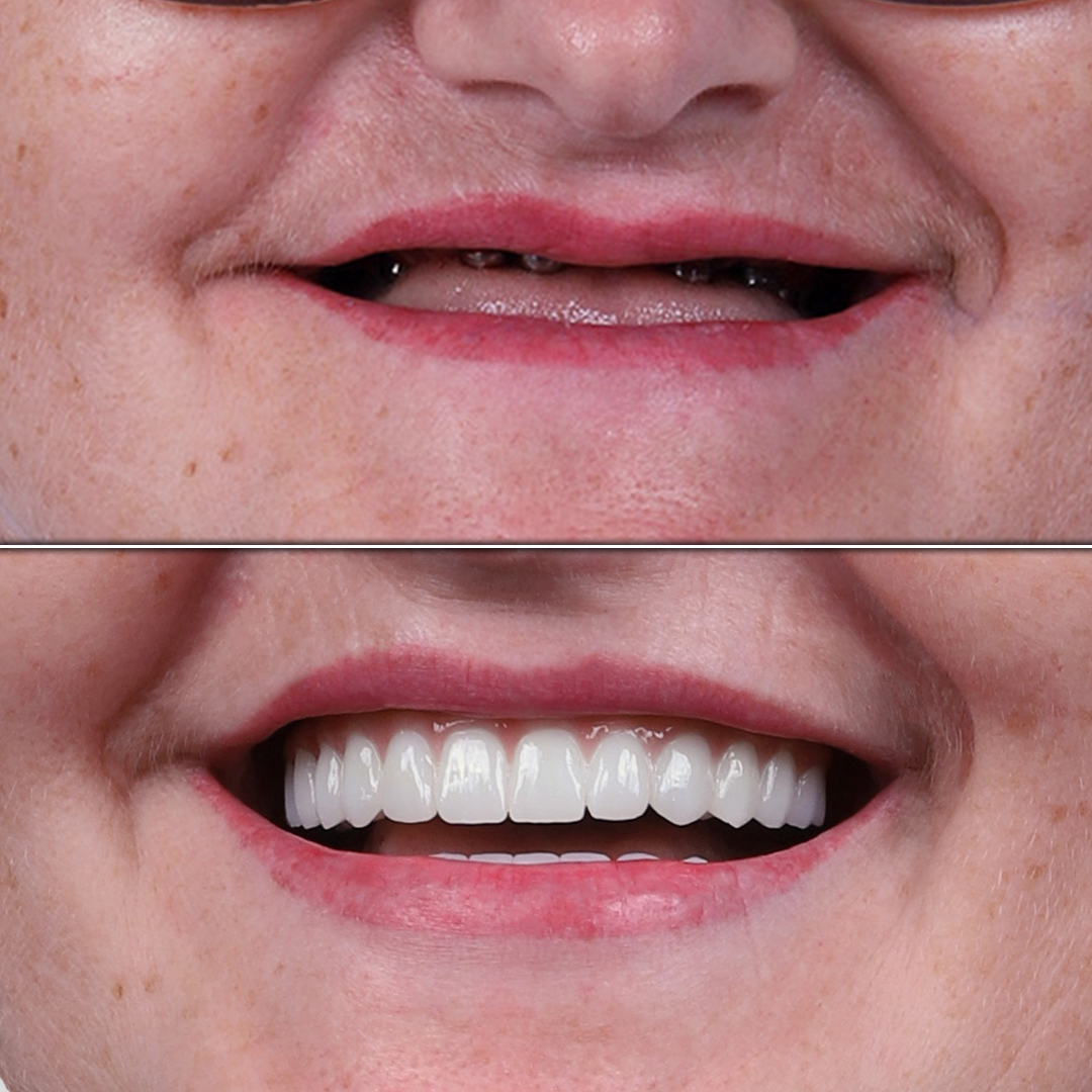 Dental_Implant_1-kopya.jpg