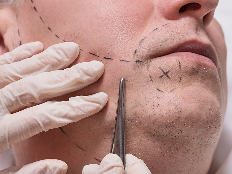 Defining the Procedure