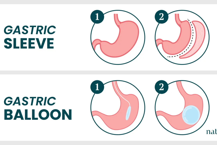 Gastric Balloon vs. Gastric Sleeve in Turkey