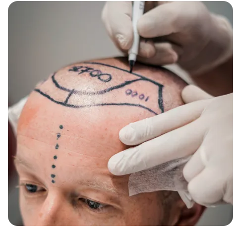 Transplant Site Preparation