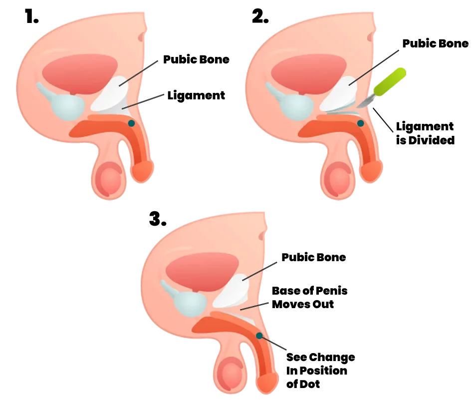 Liposuction Procedure