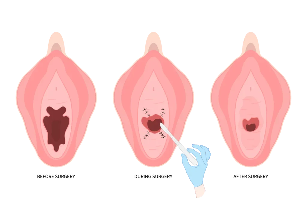 Liposuction Procedure