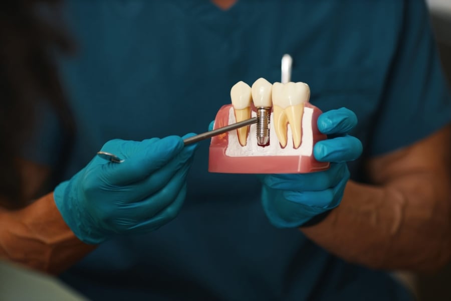 Dental Implants in Turkey: Cost, Procedure, Benefits & What to Expect
