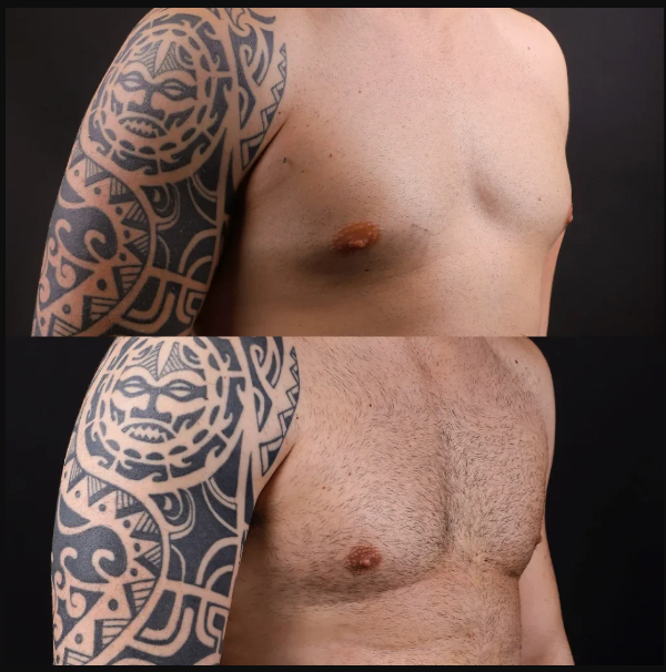 Gynecomastia before and after results in Turkey male chest reduction surgery