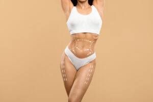 Abdominoplasty (tummy tuck) before and after result showing flatter abdomen and body contour in Turkey