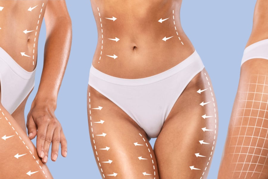 What Is BBL Surgery? Procedure Explained Step by Step