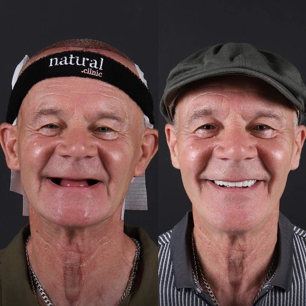 Robert M. &ndash; Full Dental Implants