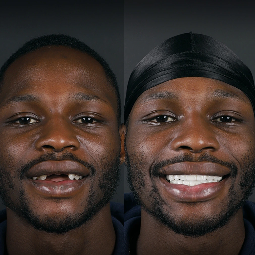 James K. &ndash; Complete Smile Makeover