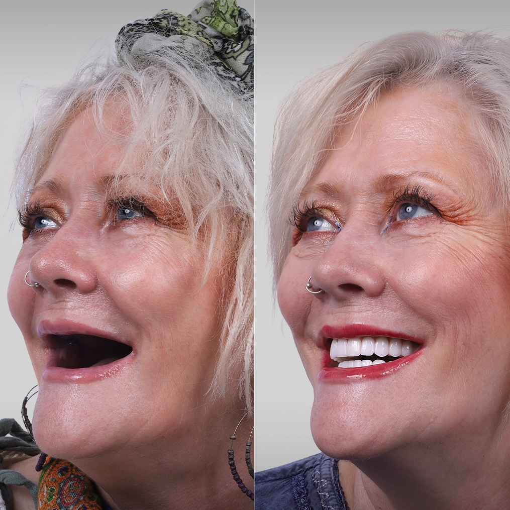 Linda S. &ndash; Full Mouth Restoration