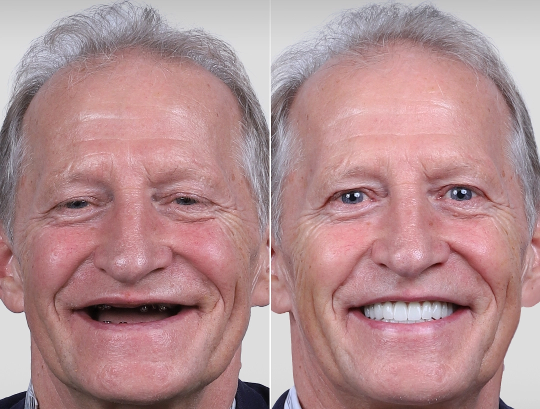 Richard H. &ndash; Full Dental Implants