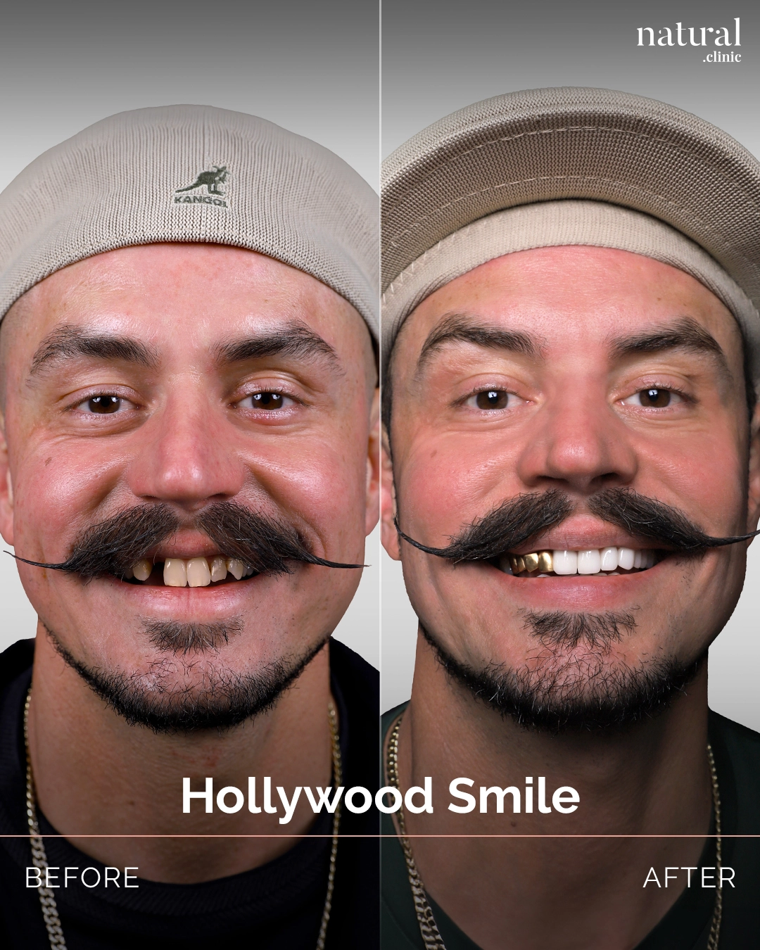 Patrick M. &ndash; Custom 24K Gold Crowns