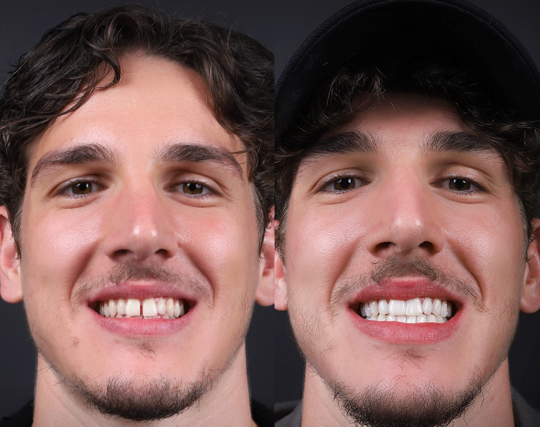 Nicolo Zaniolo &ndash; Composite Veneers