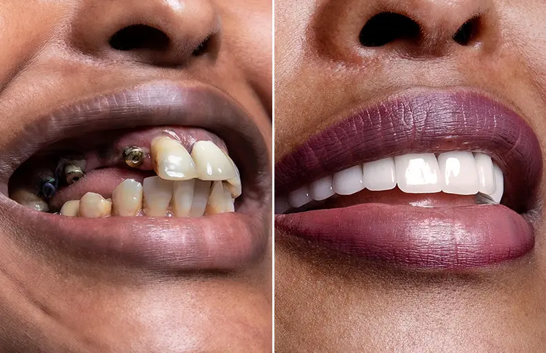 Dental Implants
