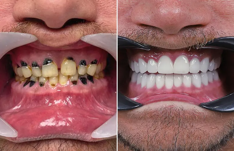 Zirconia Crowns