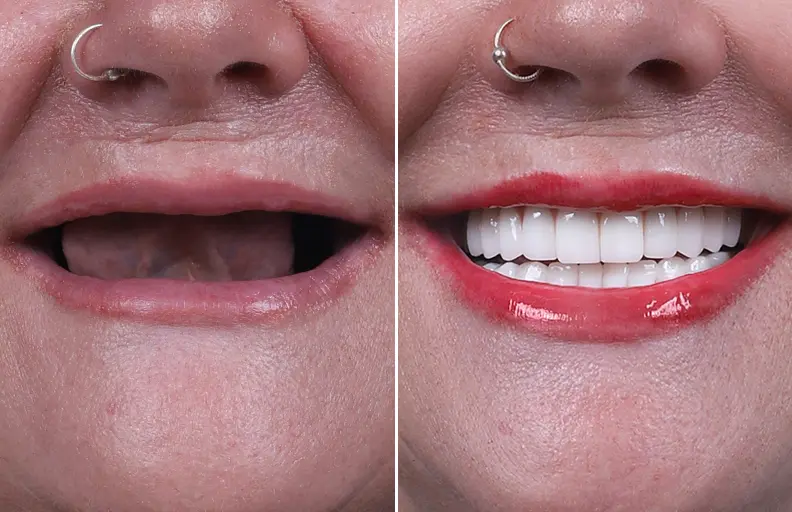 Bone Loss Implants (Zygomatic)