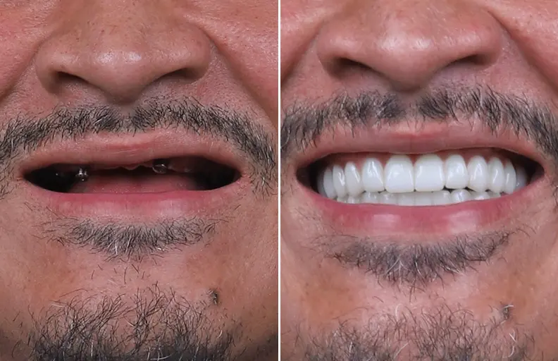 Full Mouth Implants