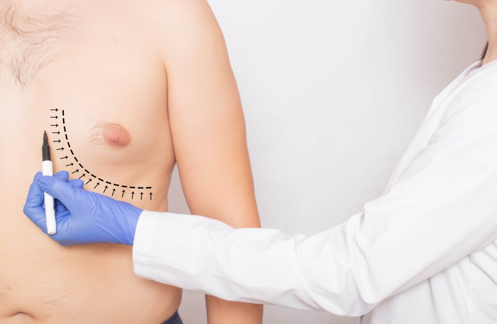 Gynecomastia surgery in Turkey before and after male chest treatment